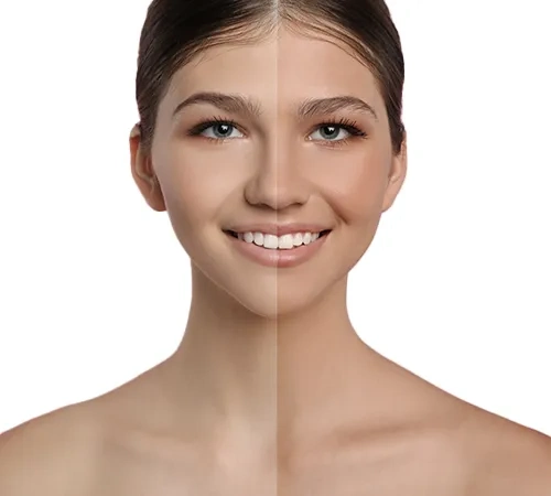 Laser Hair Removal Treatment